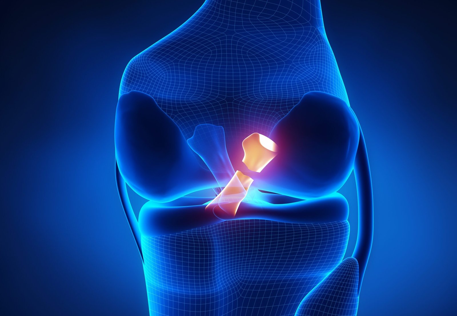 Anterior Cruciate Ligament (ACL) surgery in rewa