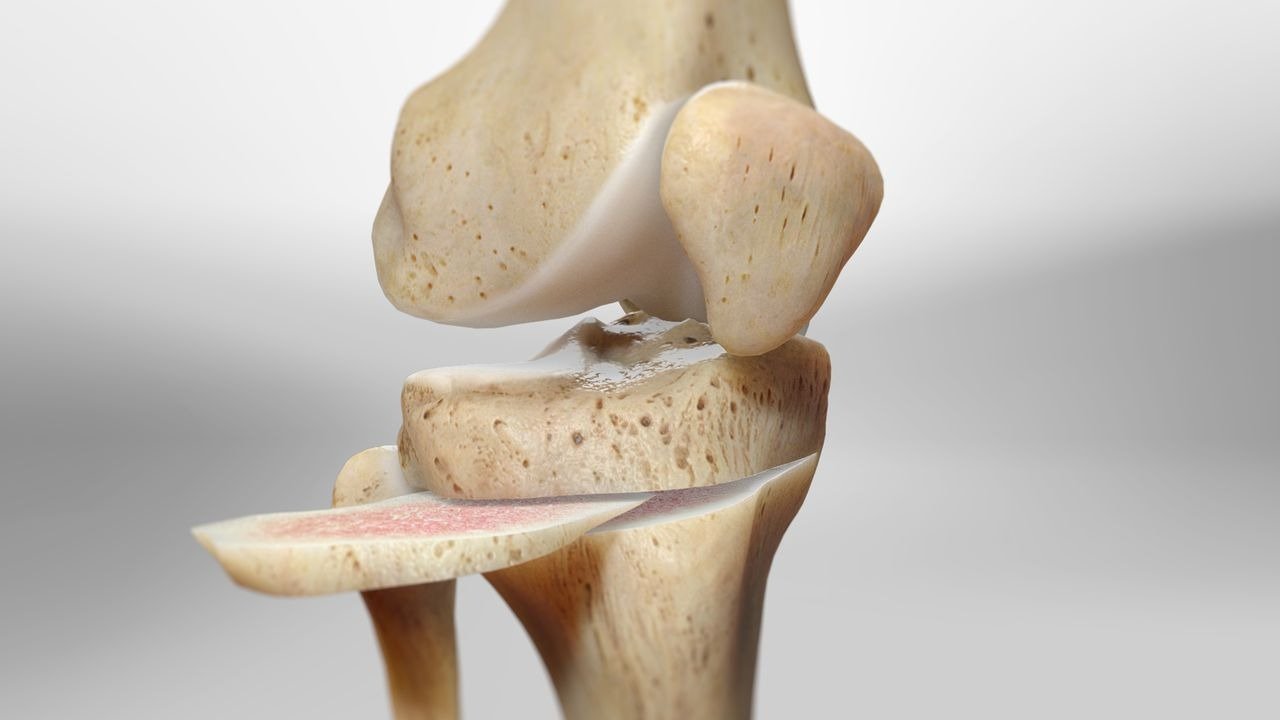 High Tibial Osteotomy  Surgery