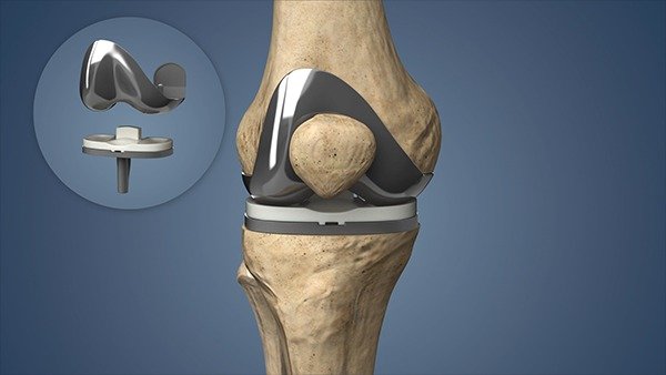 Knee Joint Replacement Surgery in rewa