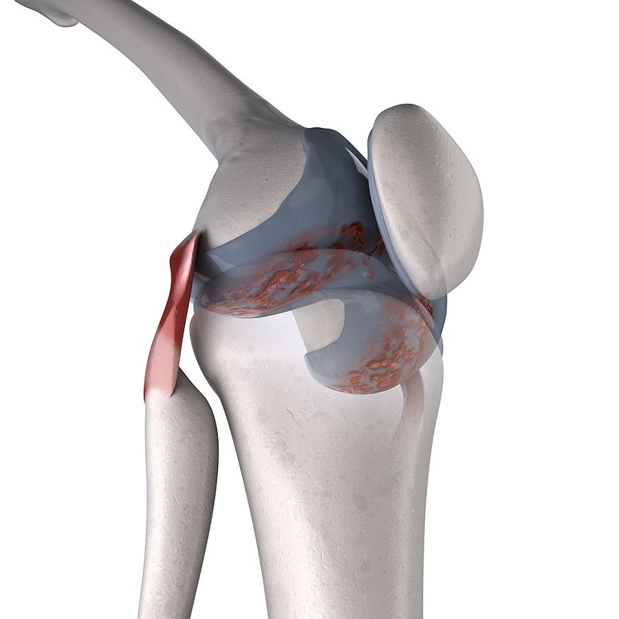 Lateral Collateral Ligament treatment in rewa