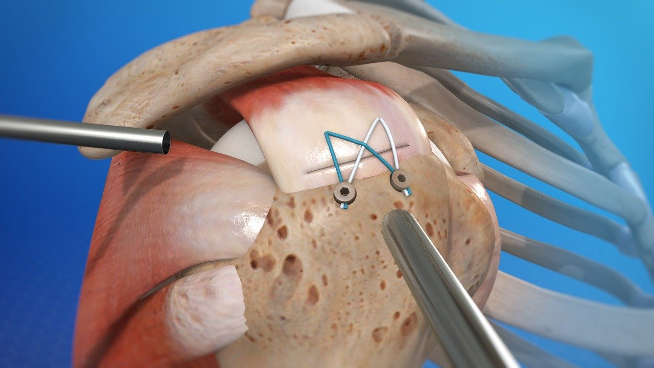 Rotator Cuff Repair in rewa